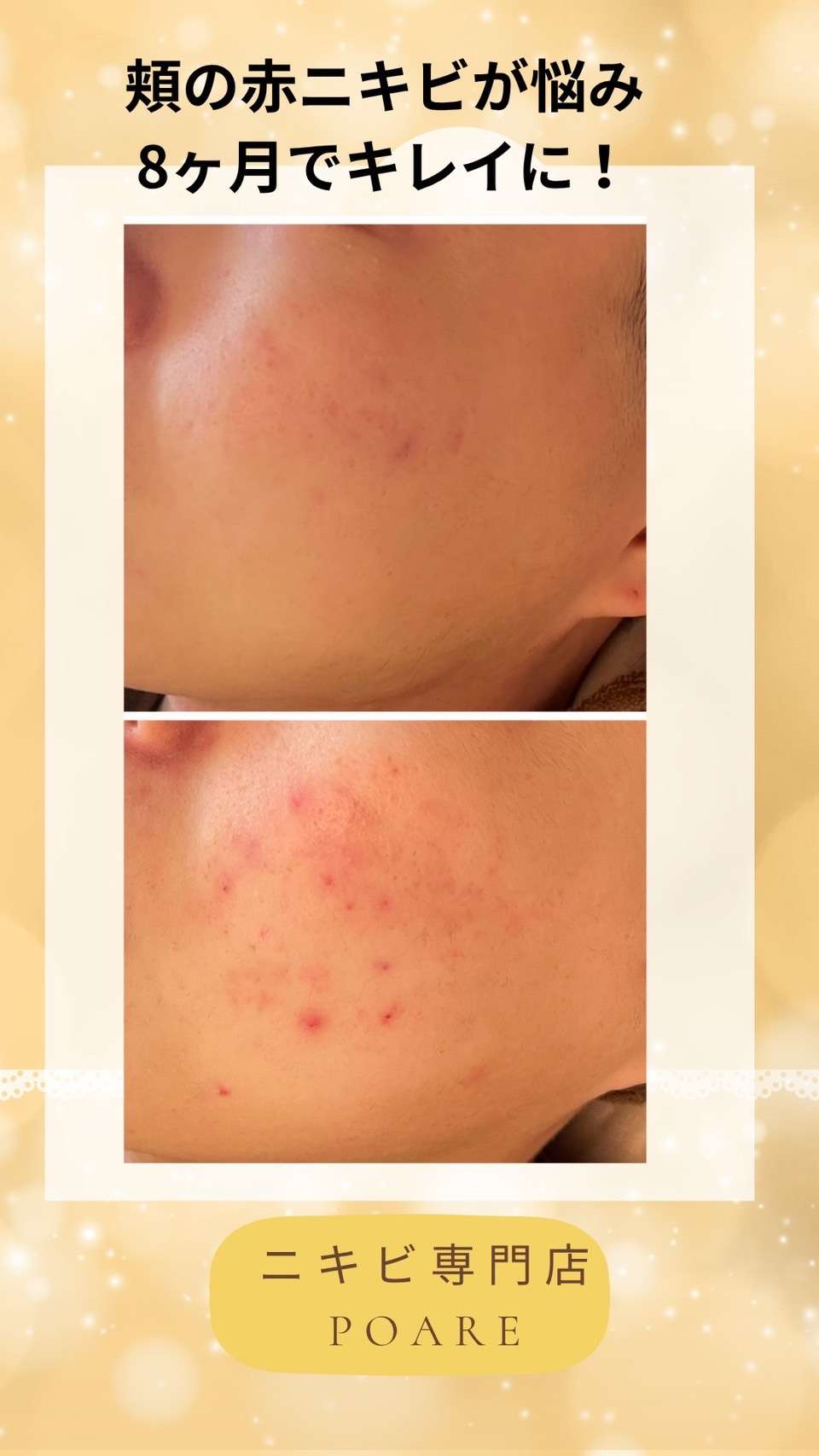 肌荒れトラブル　豊橋市ニキビ専門店