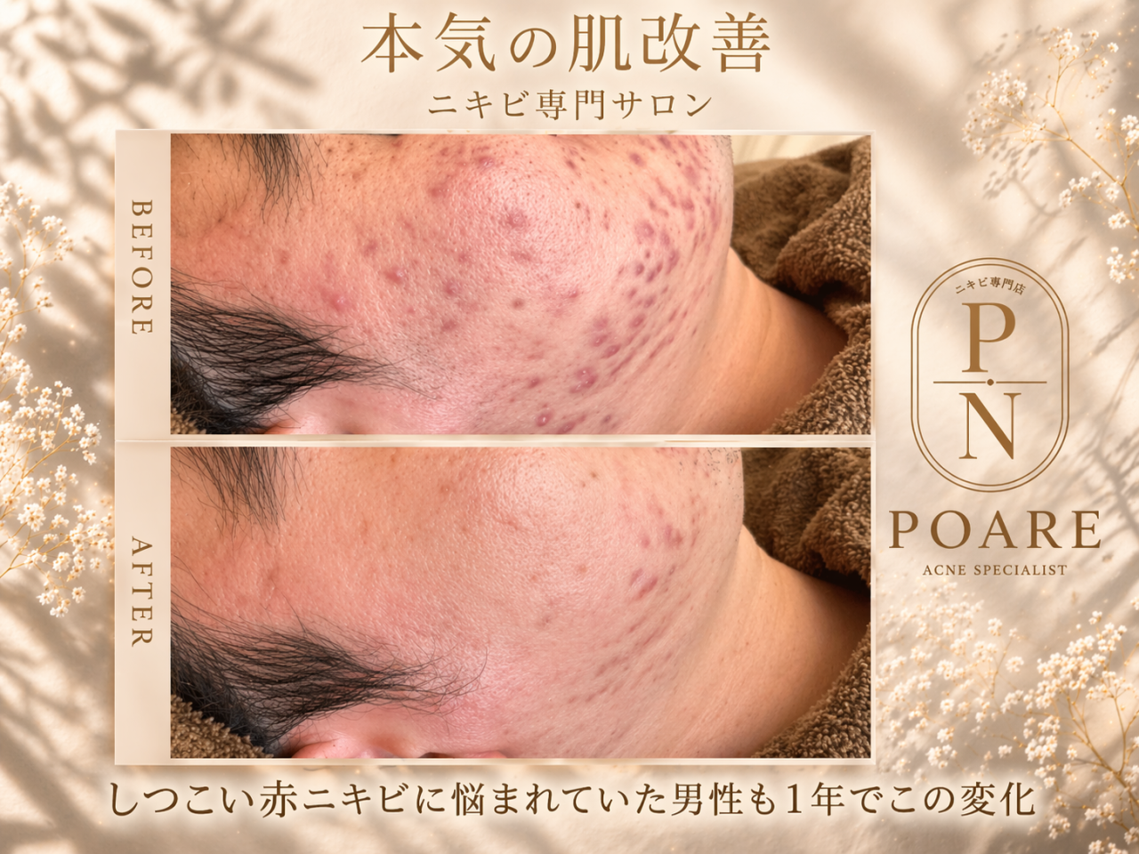 ニキビ•赤み改善方法は種類によって違う