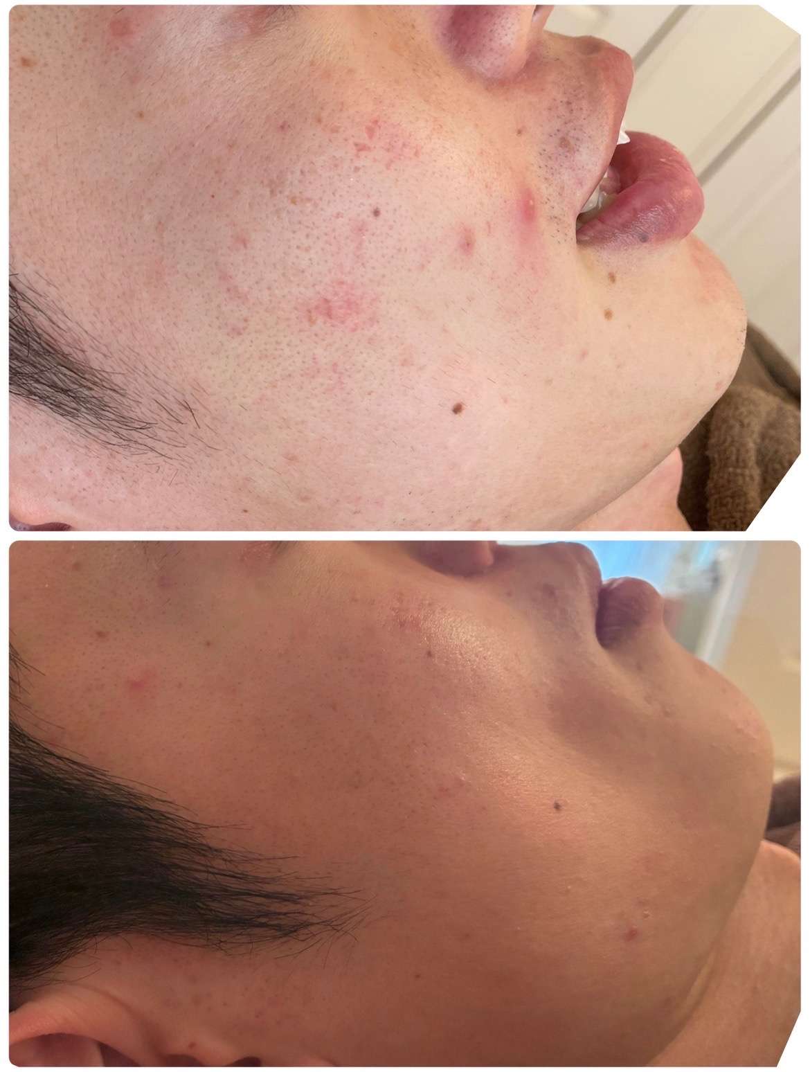 繰り返しできるニキビに悩んでる男性