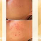 肌荒れトラブル　豊橋市ニキビ専門店