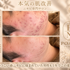 ニキビ•赤み改善方法は種類によって違う