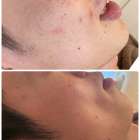 繰り返しできるニキビに悩んでる男性